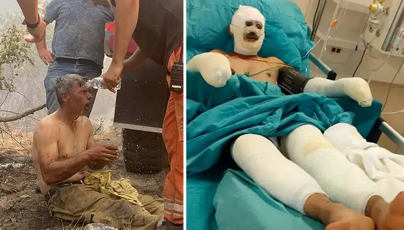 Orman İşçisinin "Yanıyorum" Feryadı: Hayata Dönüş Mücadelesi